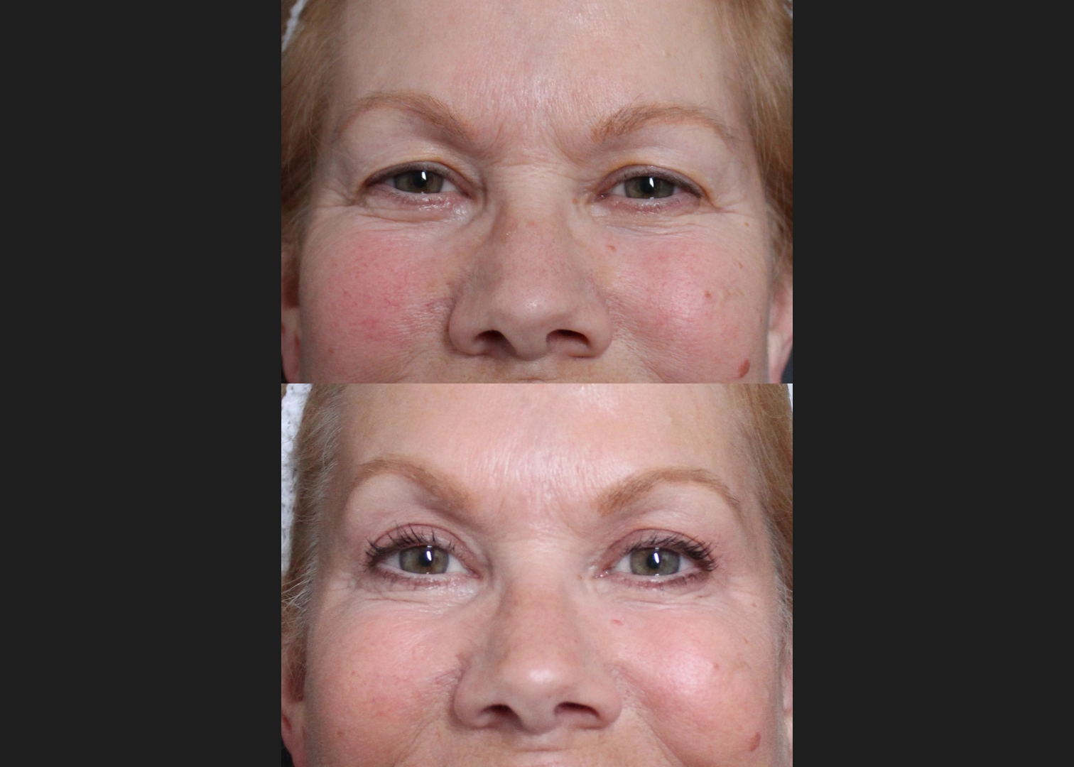 294463 Upper Blepharoplasty female before after – front