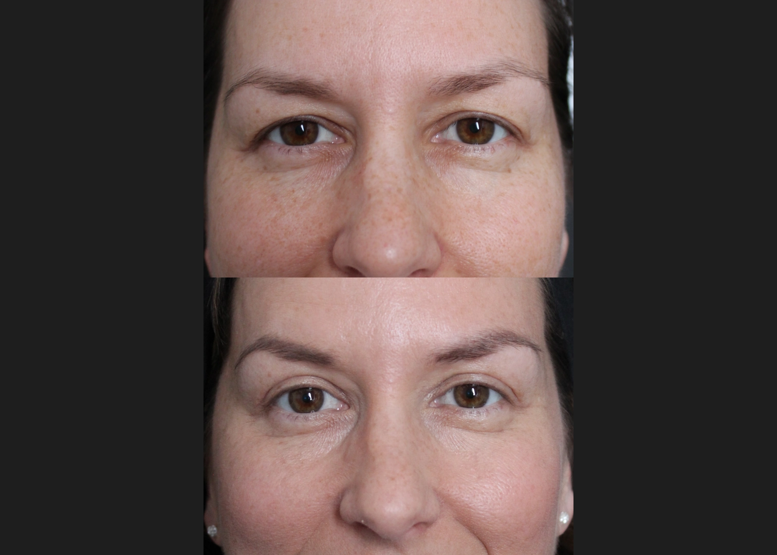 381145 female upper blepharoplasty hooded eyes before after- front