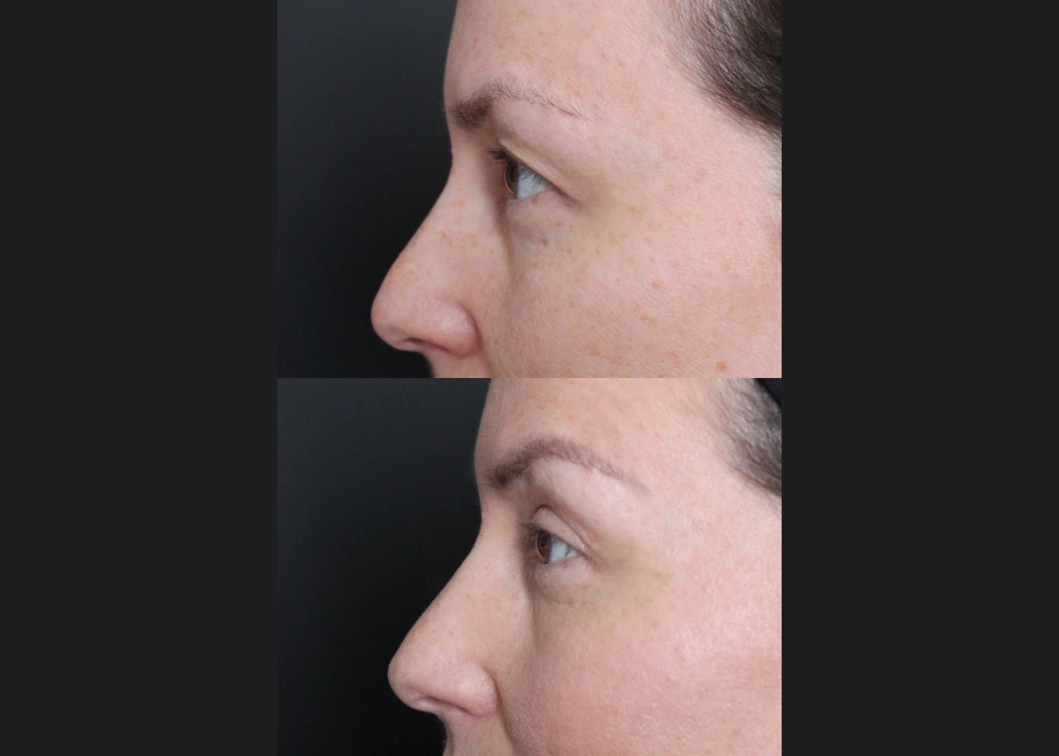 381145 female upper blepharoplasty hooded eyes before after- left