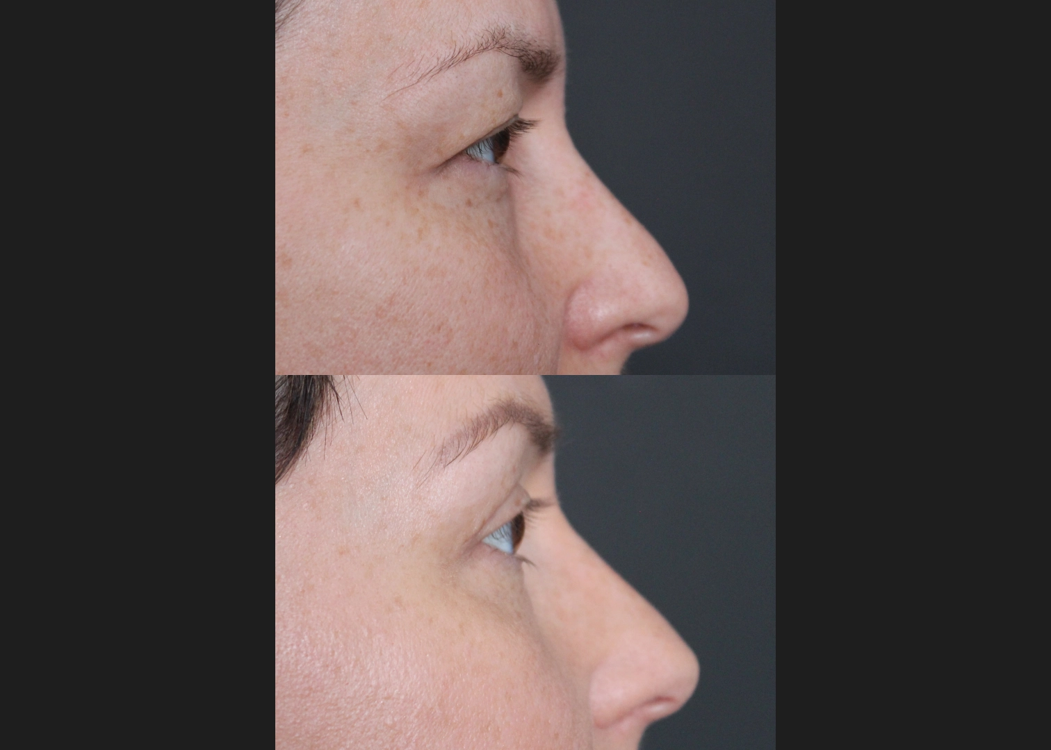 381145 female upper blepharoplasty hooded eyes before after- right