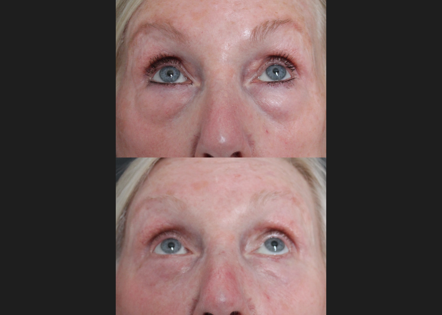 388249 Upper Lower Blepharoplasty Tear trough fat transfer female before after- front up
