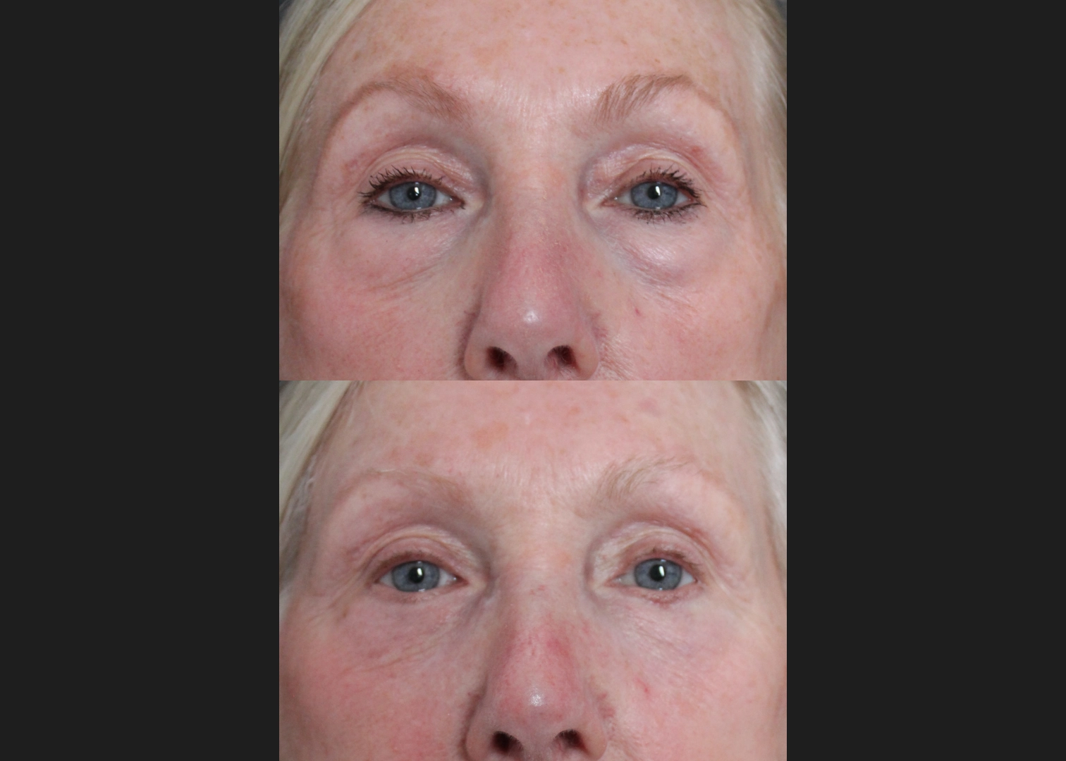 388249 Upper Lower Blepharoplasty Tear trough fat transfer female before after- front