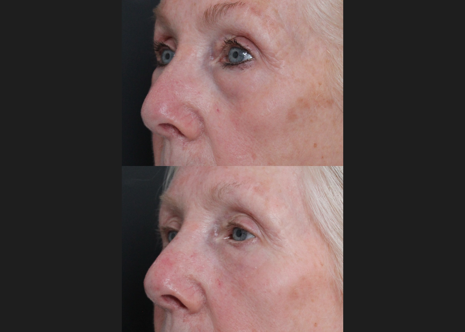 388249 Upper Lower Blepharoplasty Tear trough fat transfer female before after- left oblique