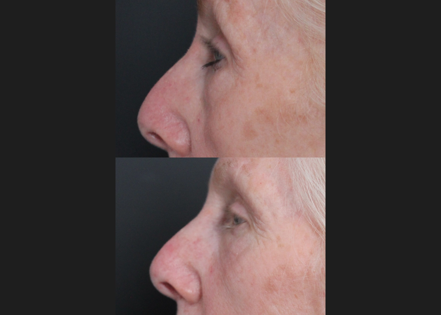 388249 Upper Lower Blepharoplasty Tear trough fat transfer female before after- left