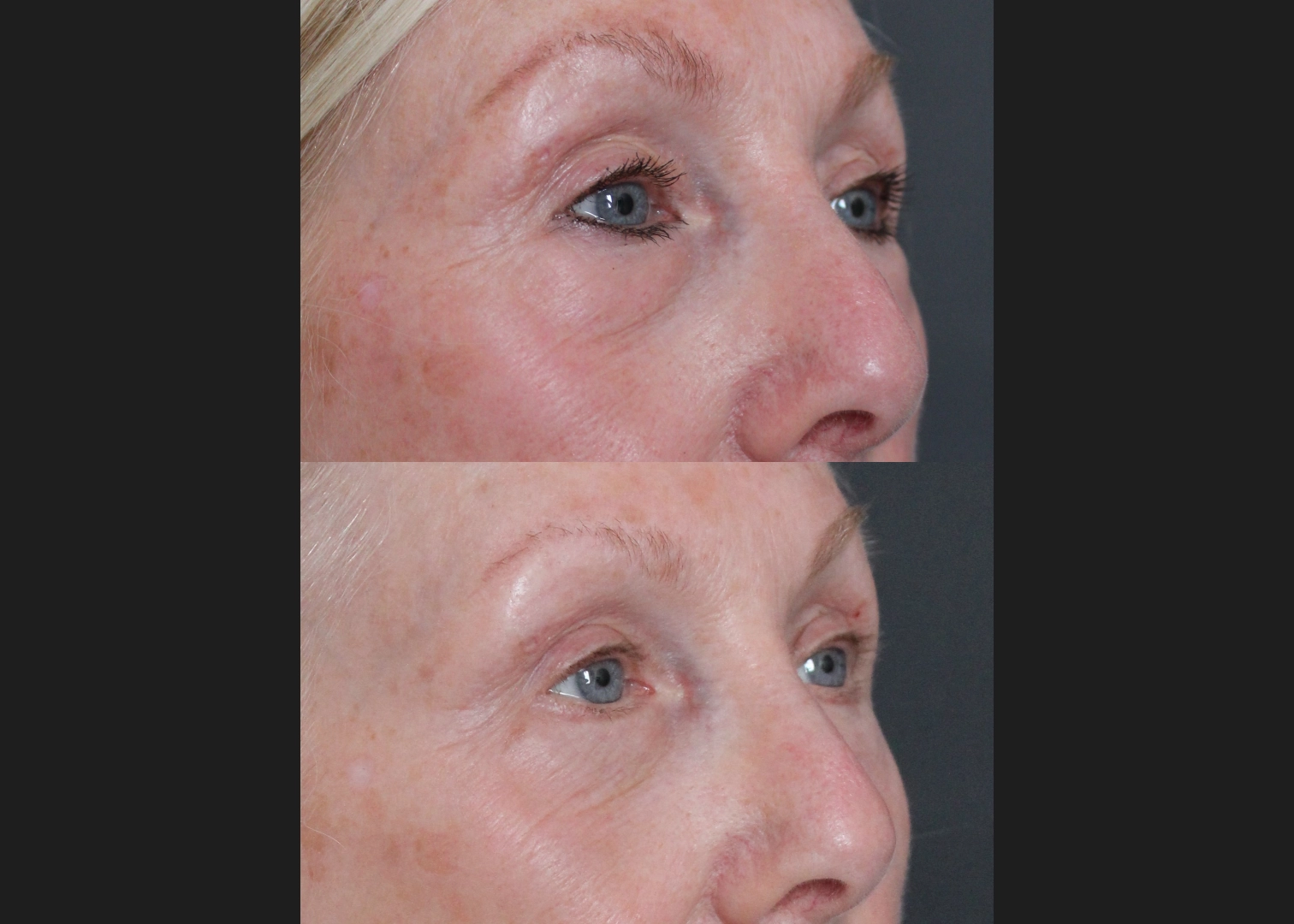 388249 Upper Lower Blepharoplasty Tear trough fat transfer female before after- right oblique