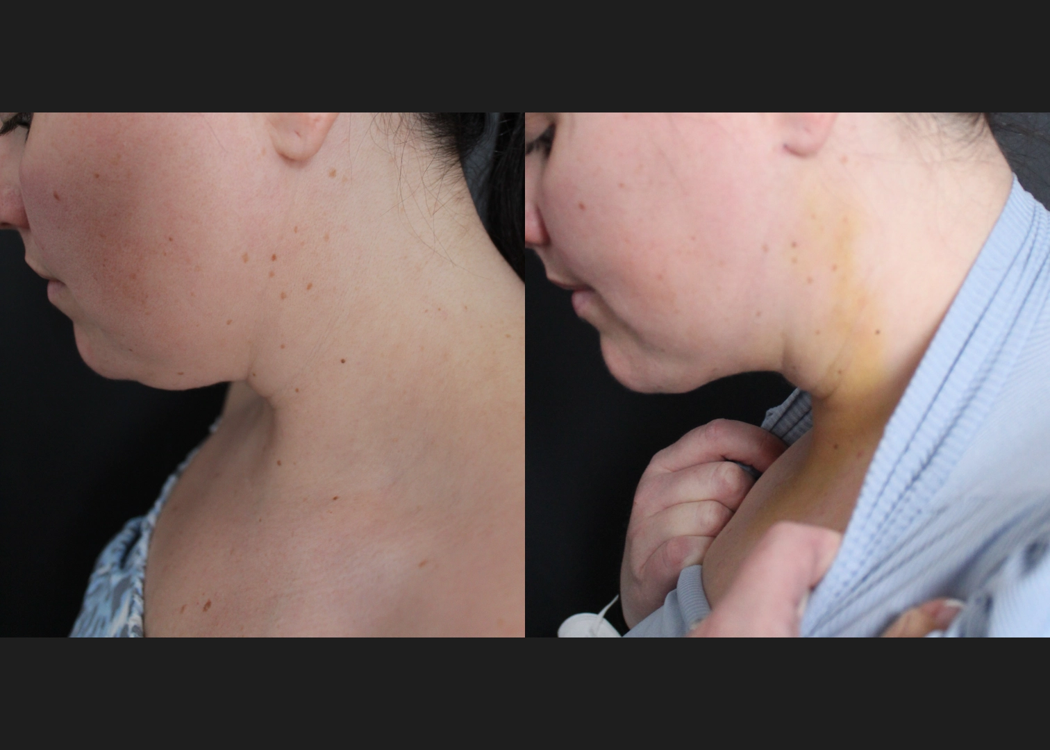 390027 submental neck vaser lipo before after- left bent