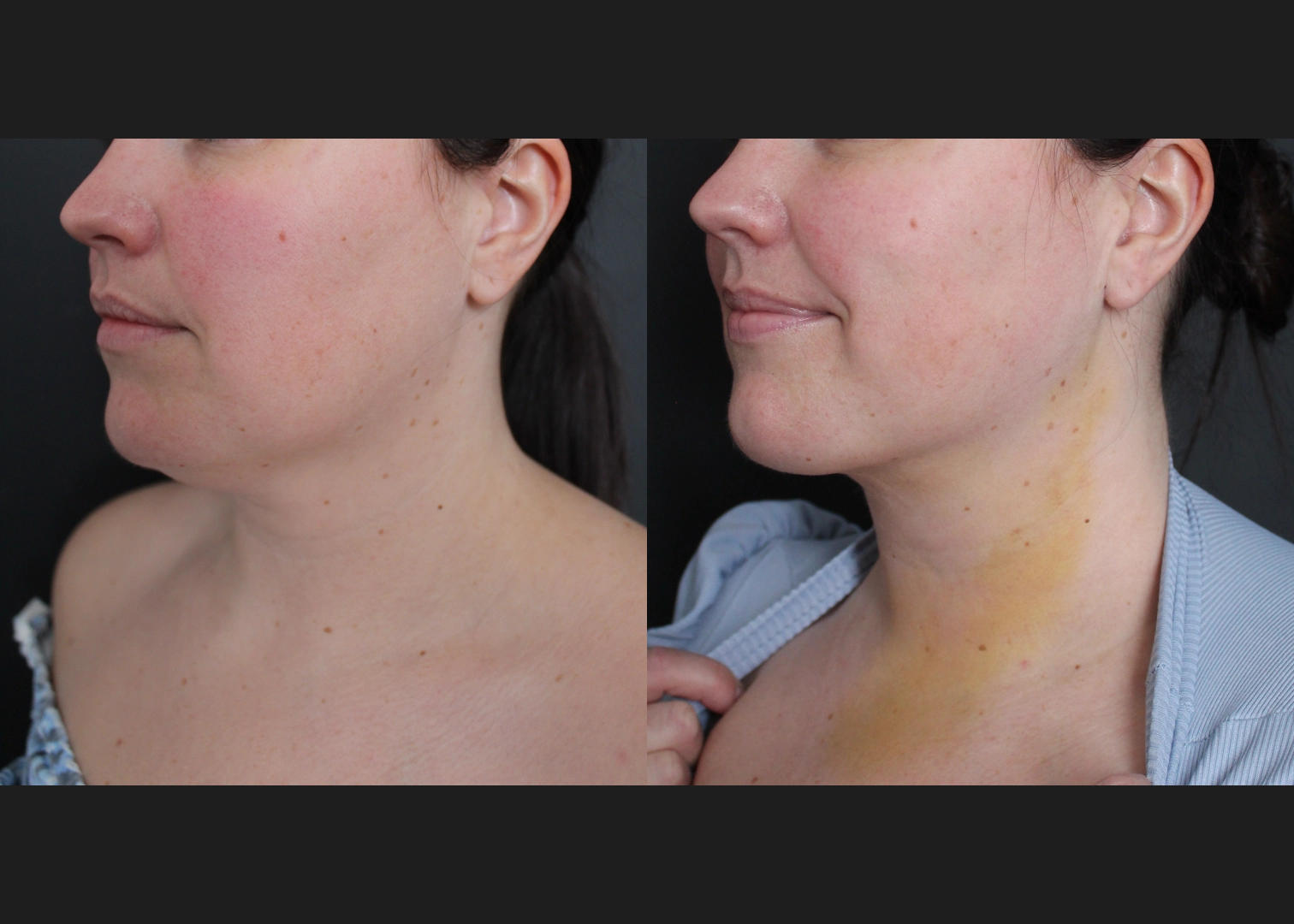390027 submental neck vaser lipo before after- left oblique