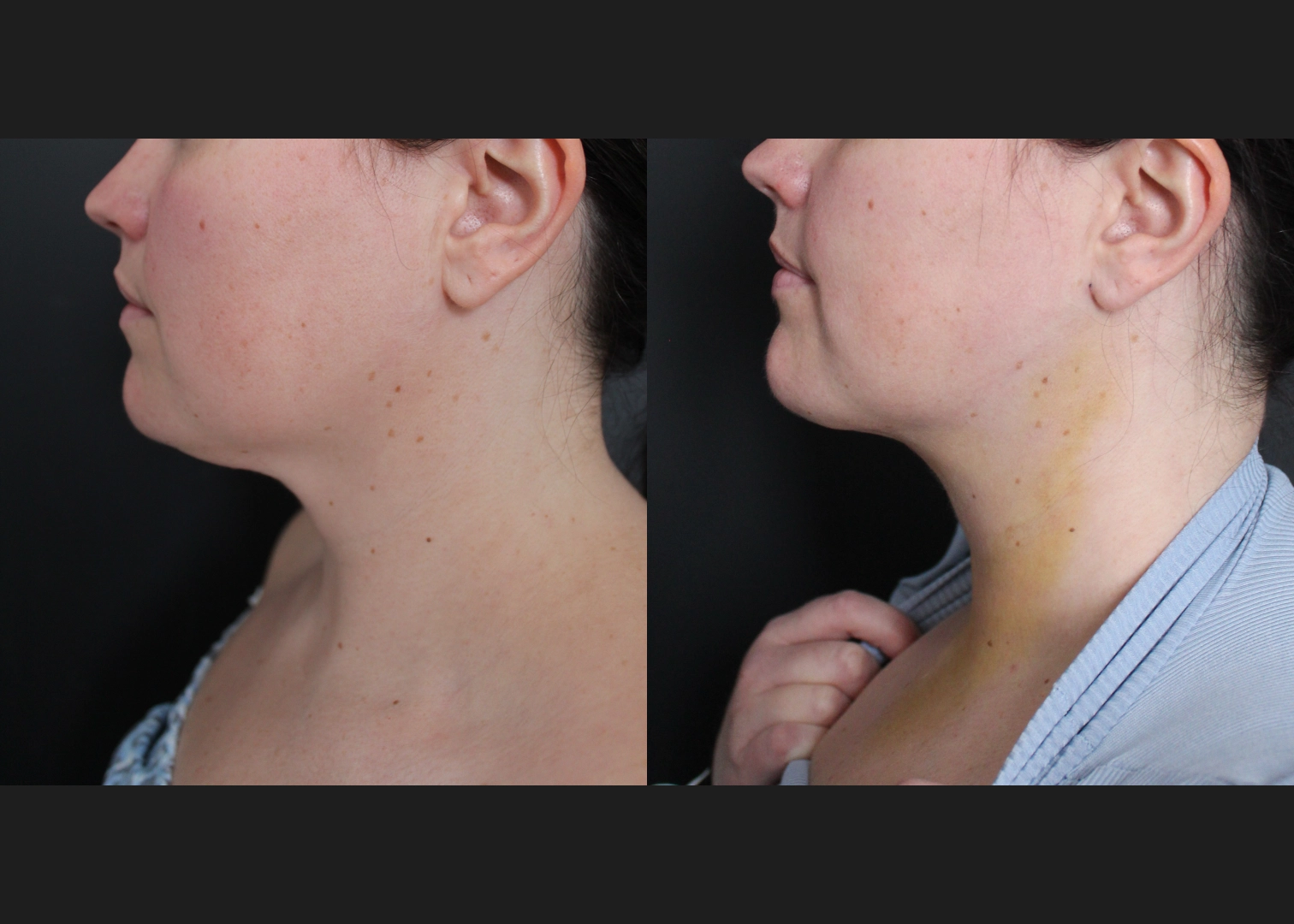 390027 submental neck vaser lipo before after- left