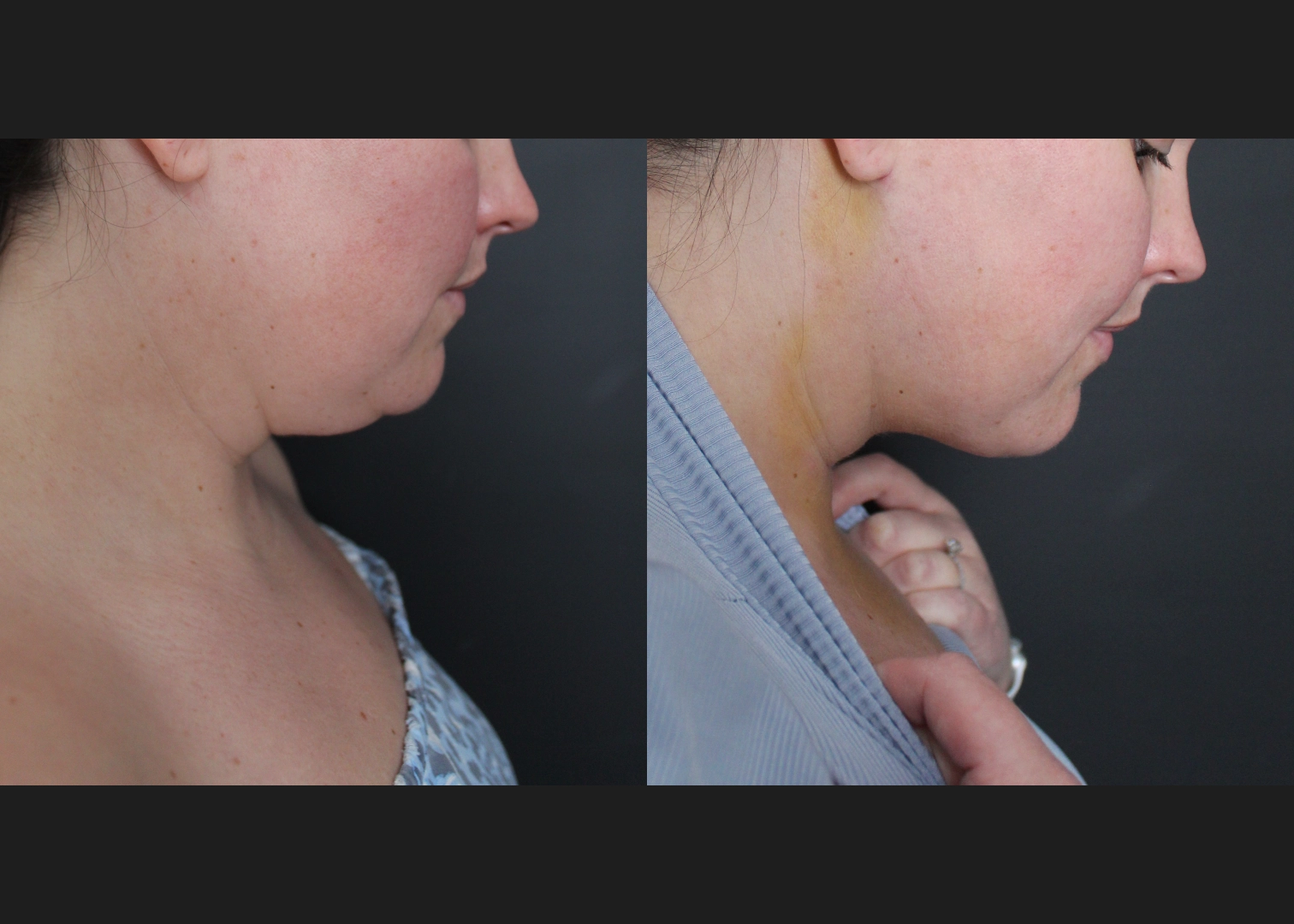 390027 submental neck vaser lipo before after- right bent