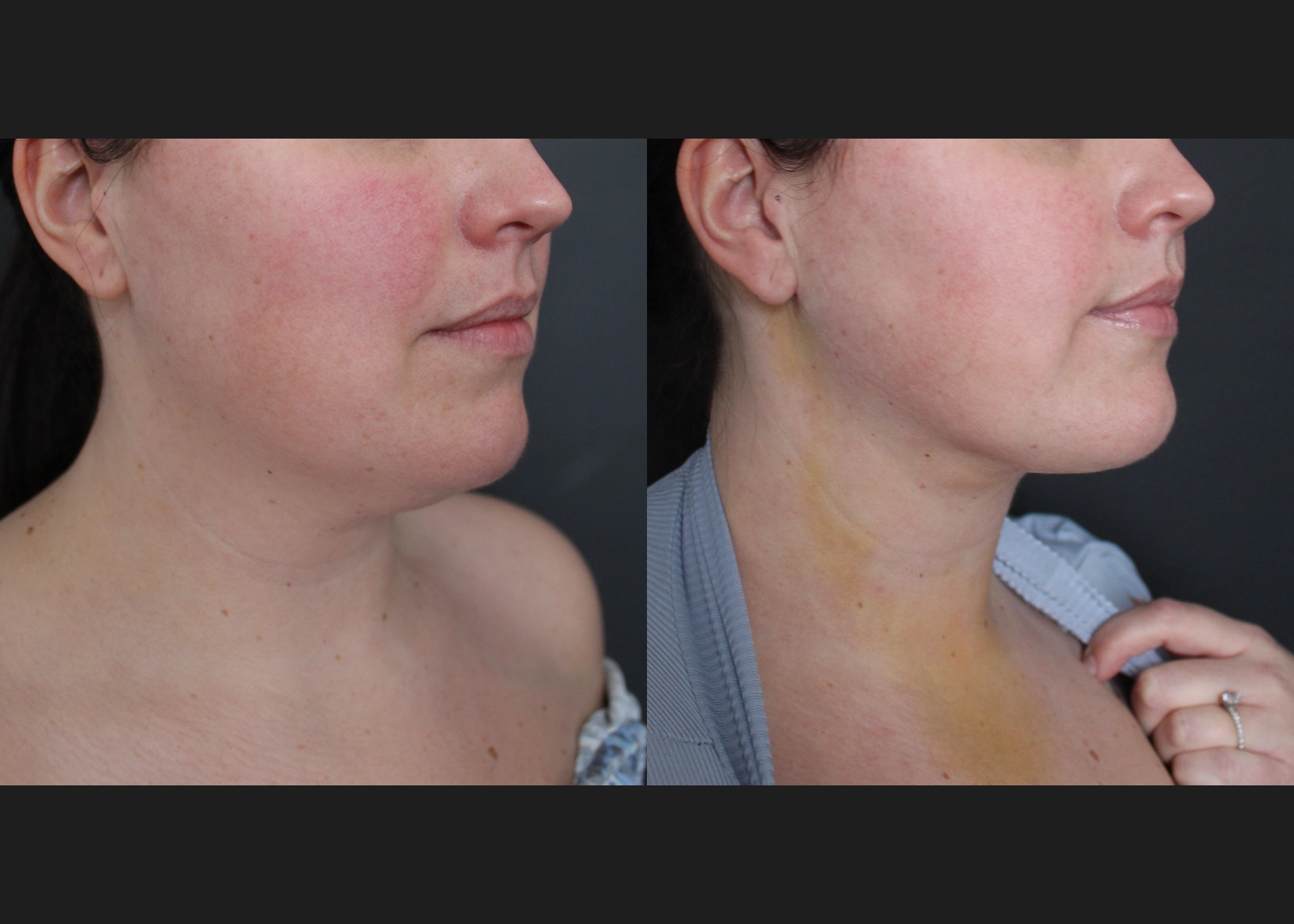 390027 submental neck vaser lipo before after- right oblique