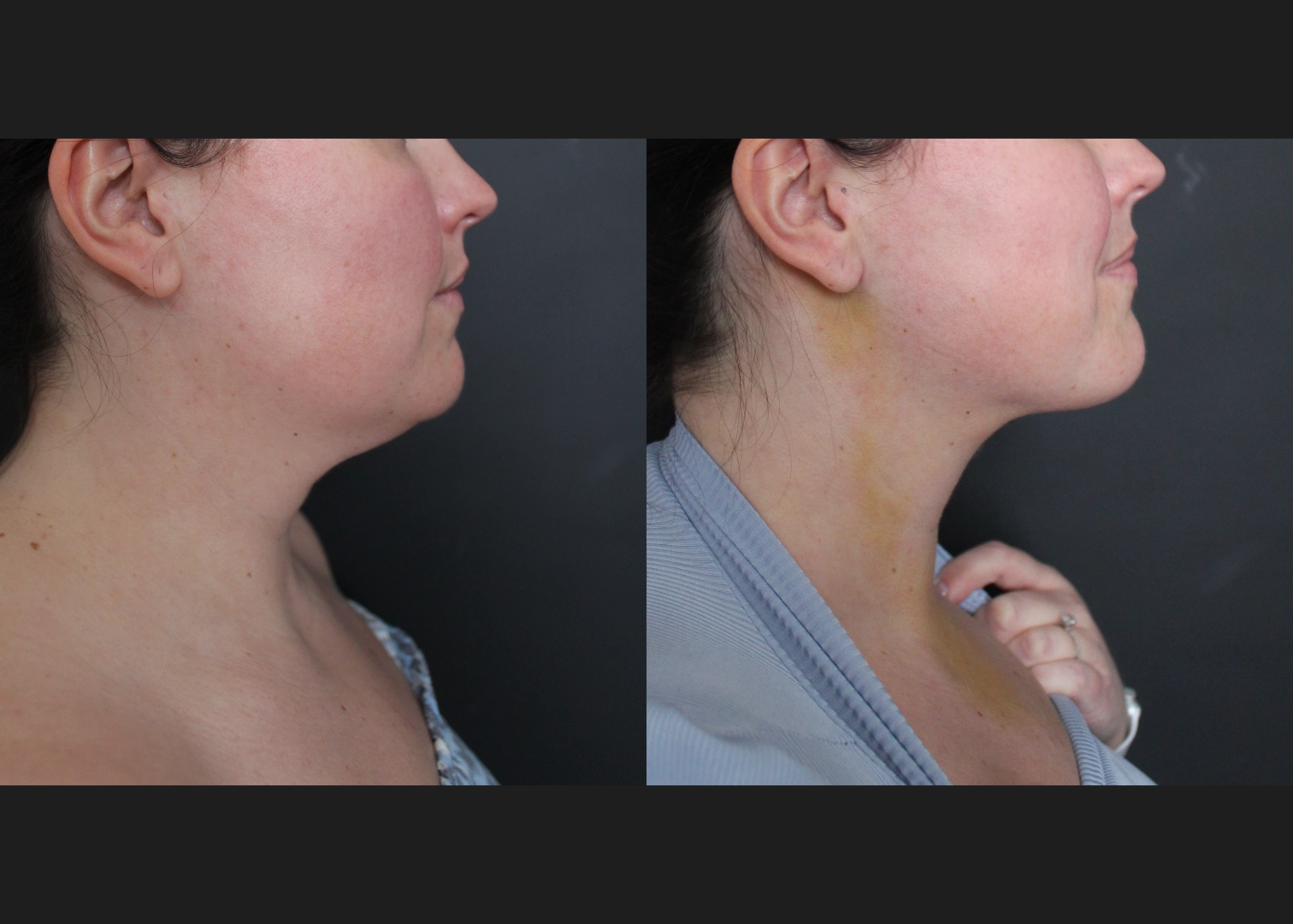 390027 submental neck vaser lipo before after- right