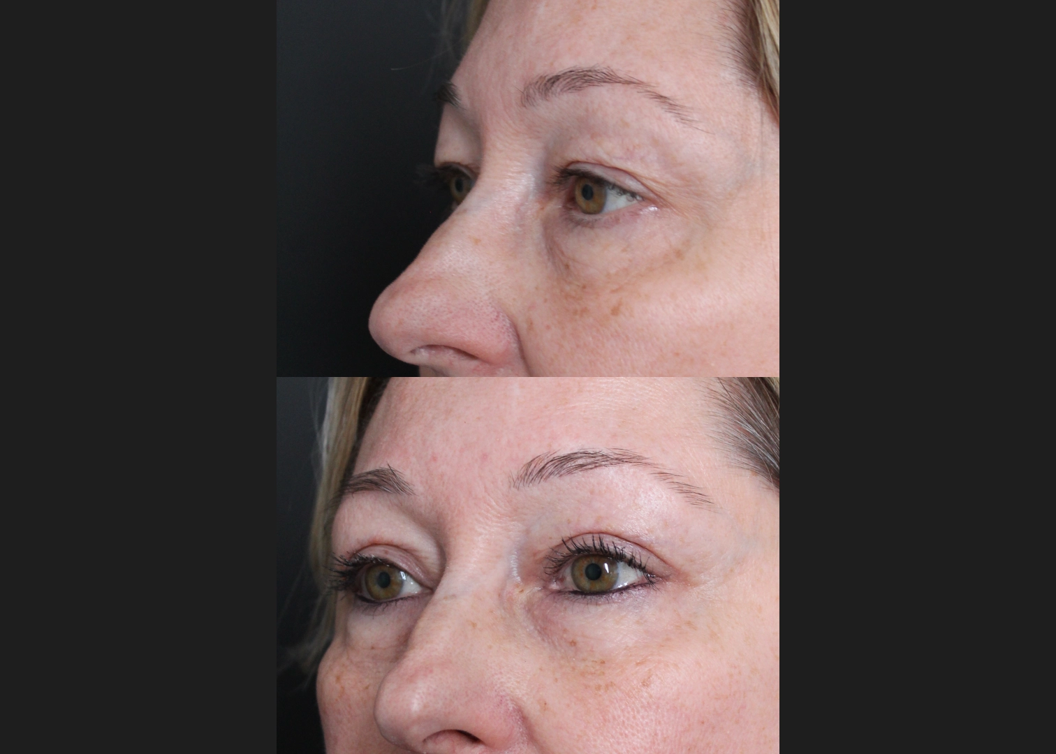 396646 Upper blepharoplasty Before After- left oblique