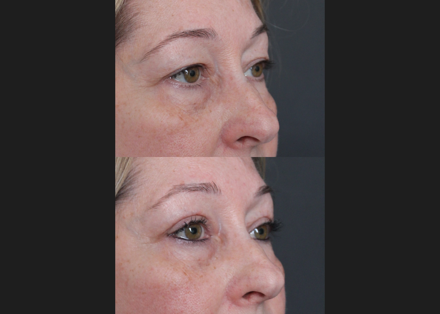 396646 Upper blepharoplasty Before After- right oblique