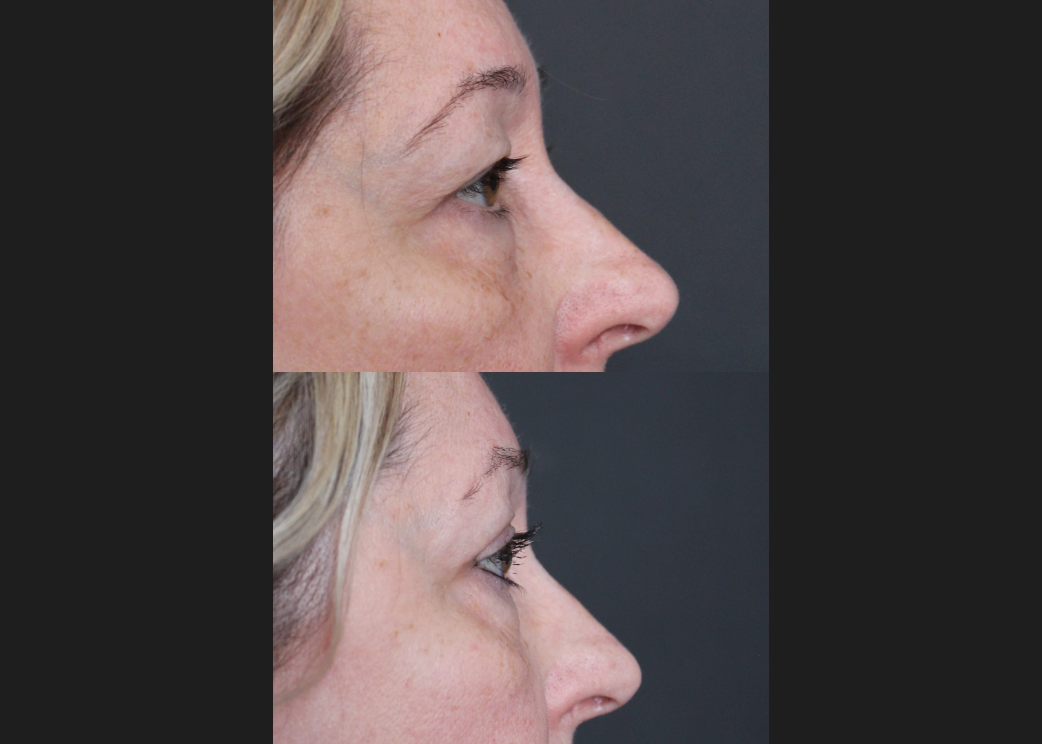 396646 Upper blepharoplasty Before After- right