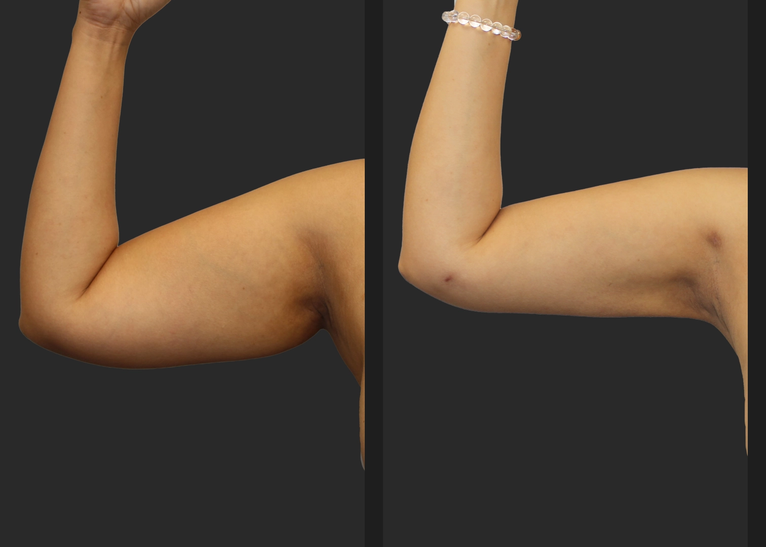 Arm Lipo Renuvion Before After Font Right Arm Bent
