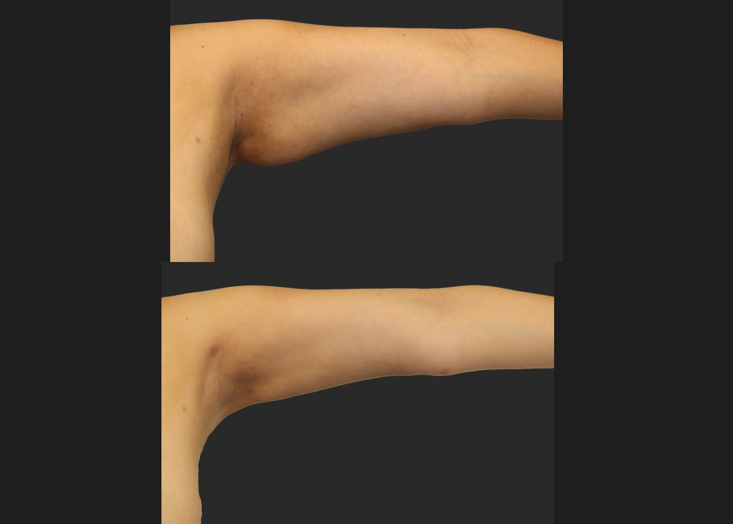 Arm Lipo Renuvion Before After Front Left Arm