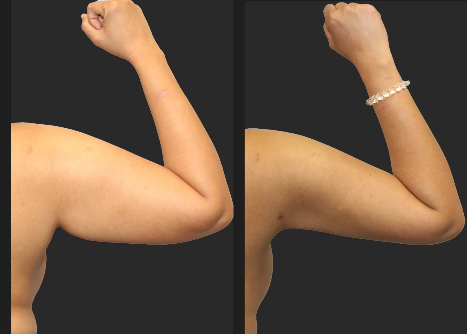 Arm Lipo Renuvion Before After Post Right Arm Bent