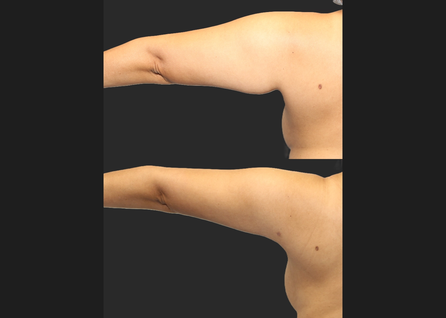 Arm Lipo Renuvion Before After- left post arm extended