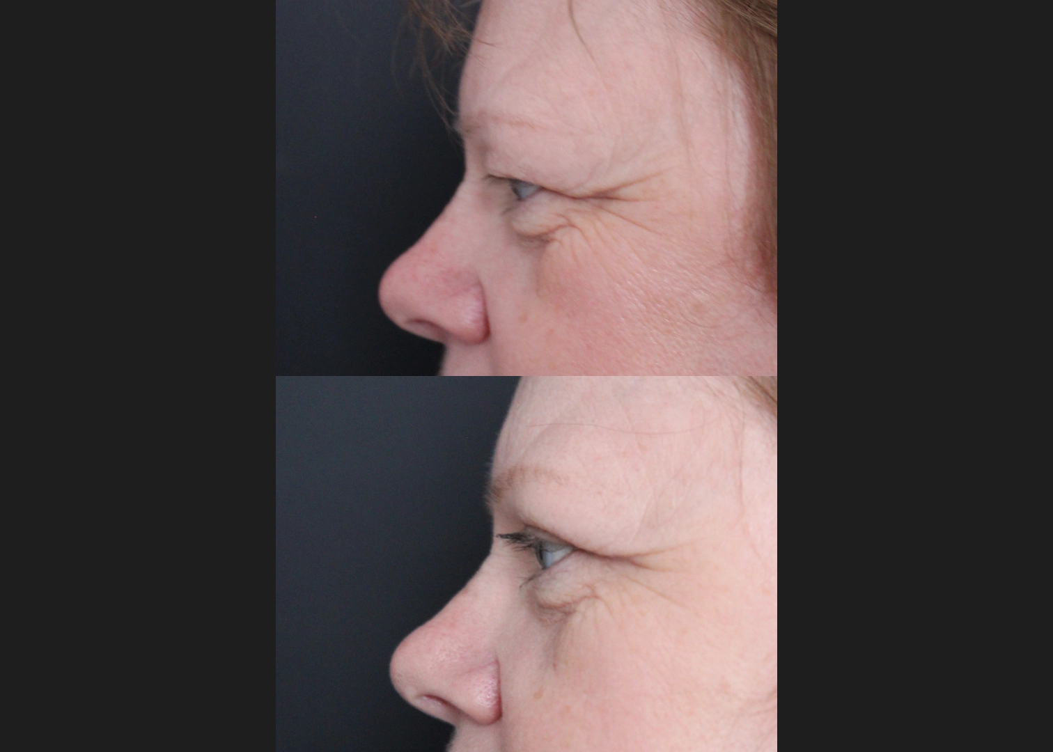 Bilateral Upper Blepharoplasty heavy hooded eyelids Before After 6 weeks- left