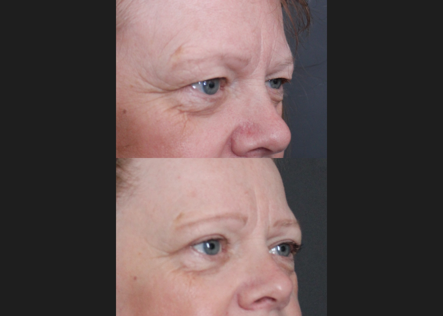 Bilateral Upper Blepharoplasty heavy hooded eyelids Before After 6 weeks- right oblique