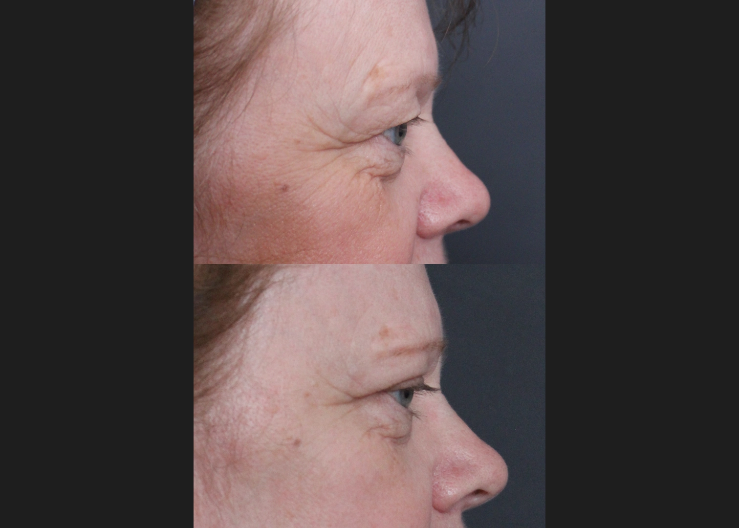 Bilateral Upper Blepharoplasty heavy hooded eyelids Before After 6 weeks- right