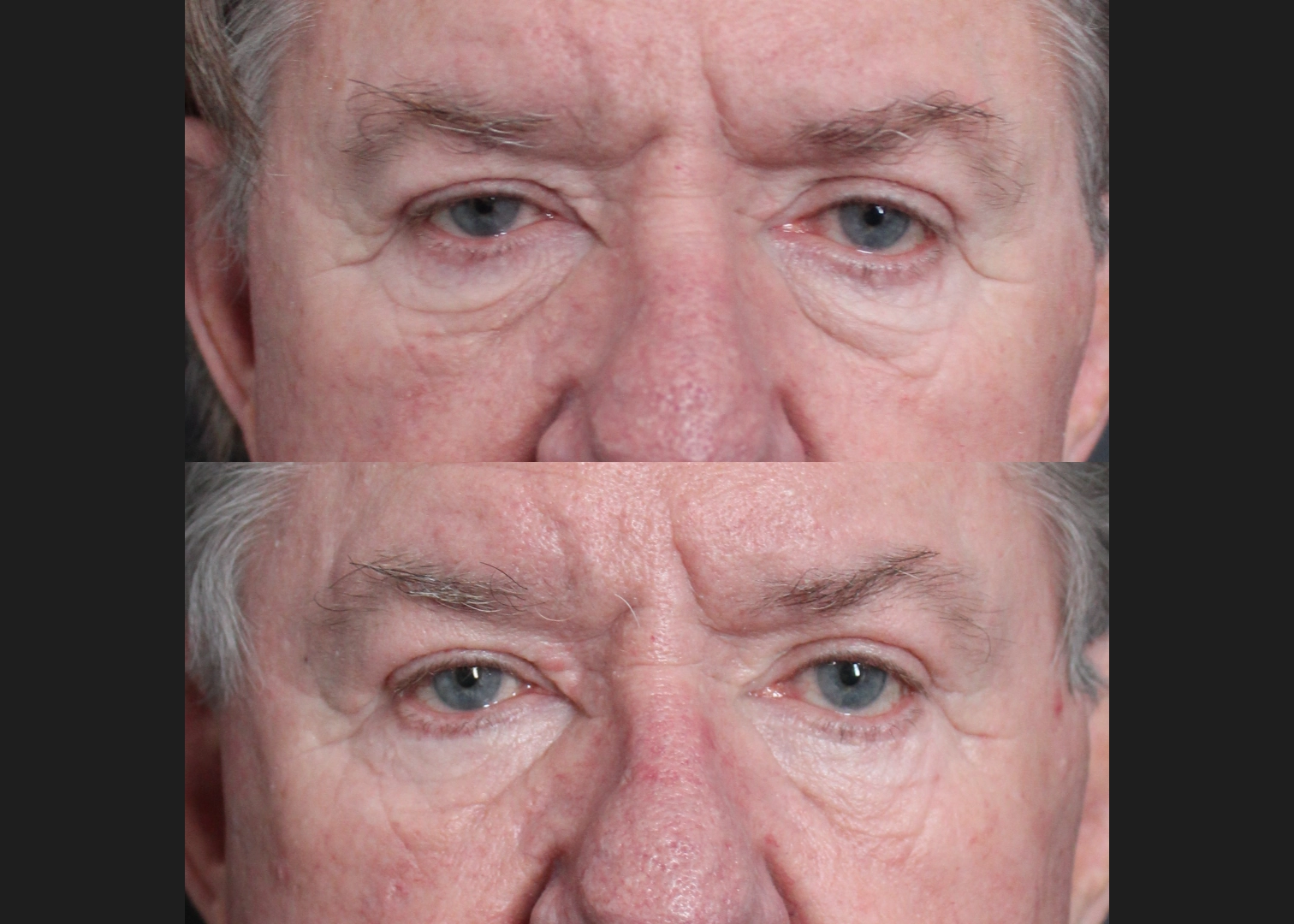 Lower Bleph Older male Before After- front