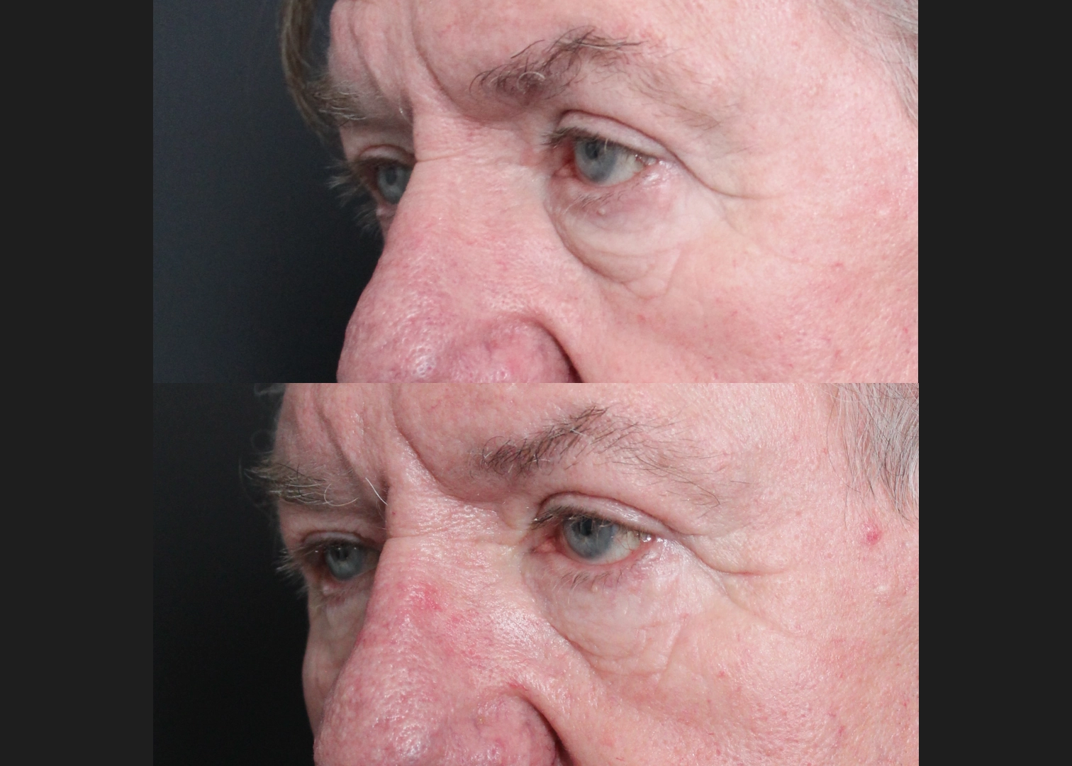 Lower Bleph Older male Before After- left oblique