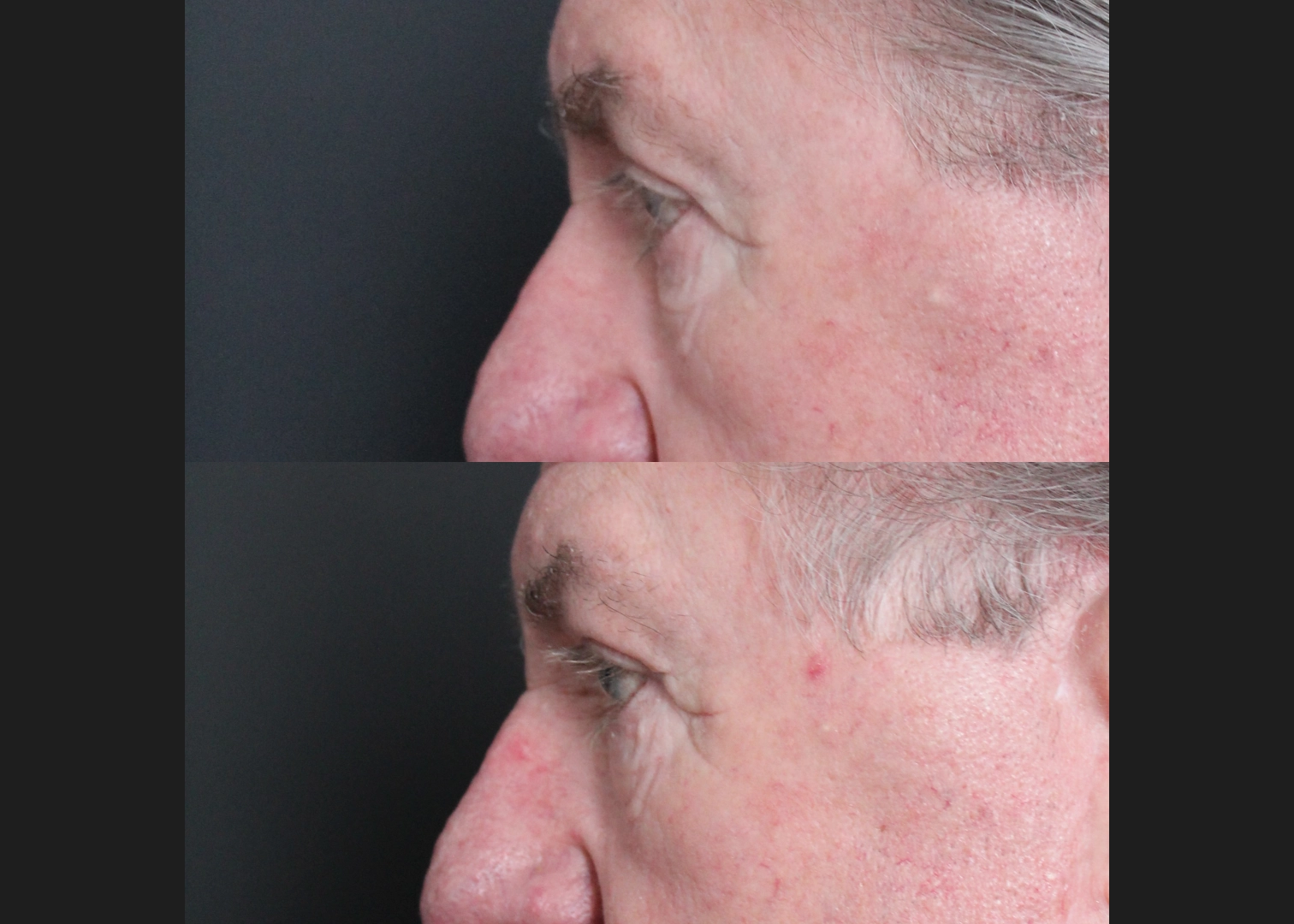 Lower Bleph Older male Before After- left