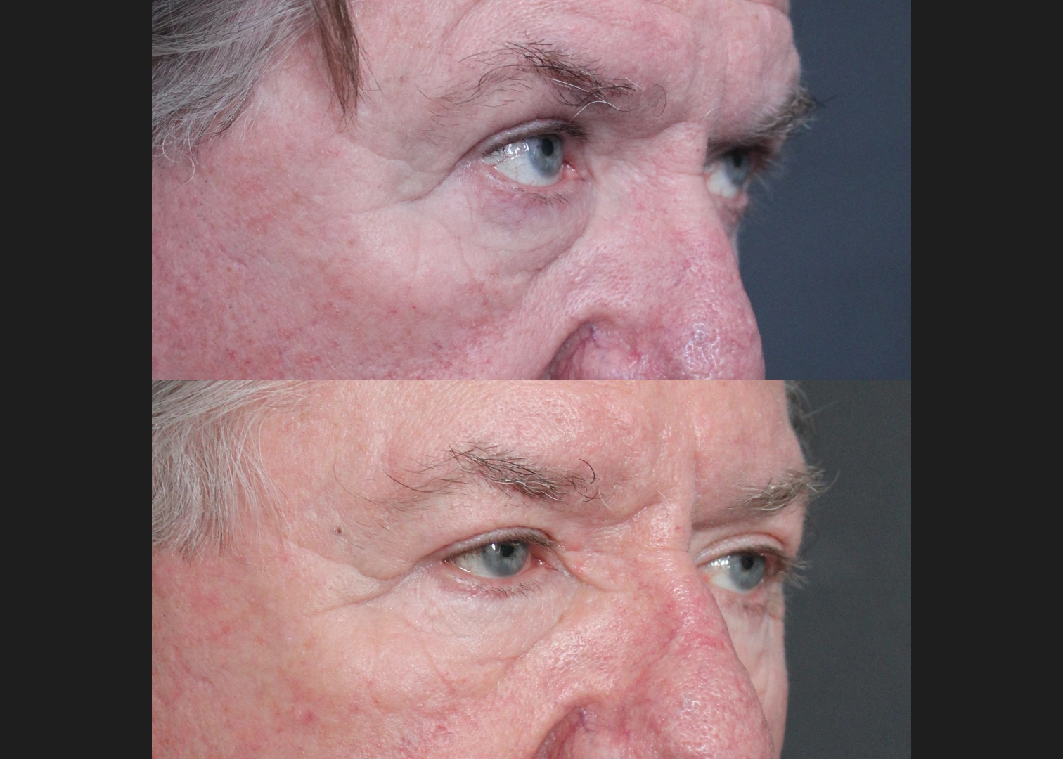 Lower Bleph Older male Before After- right oblique