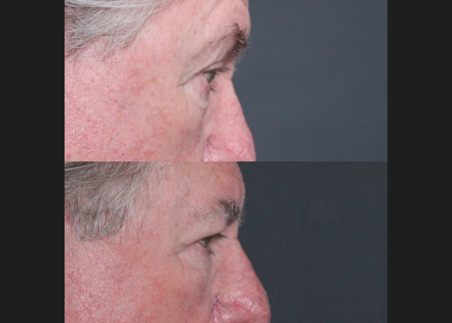 Lower Bleph Older male Before After- right