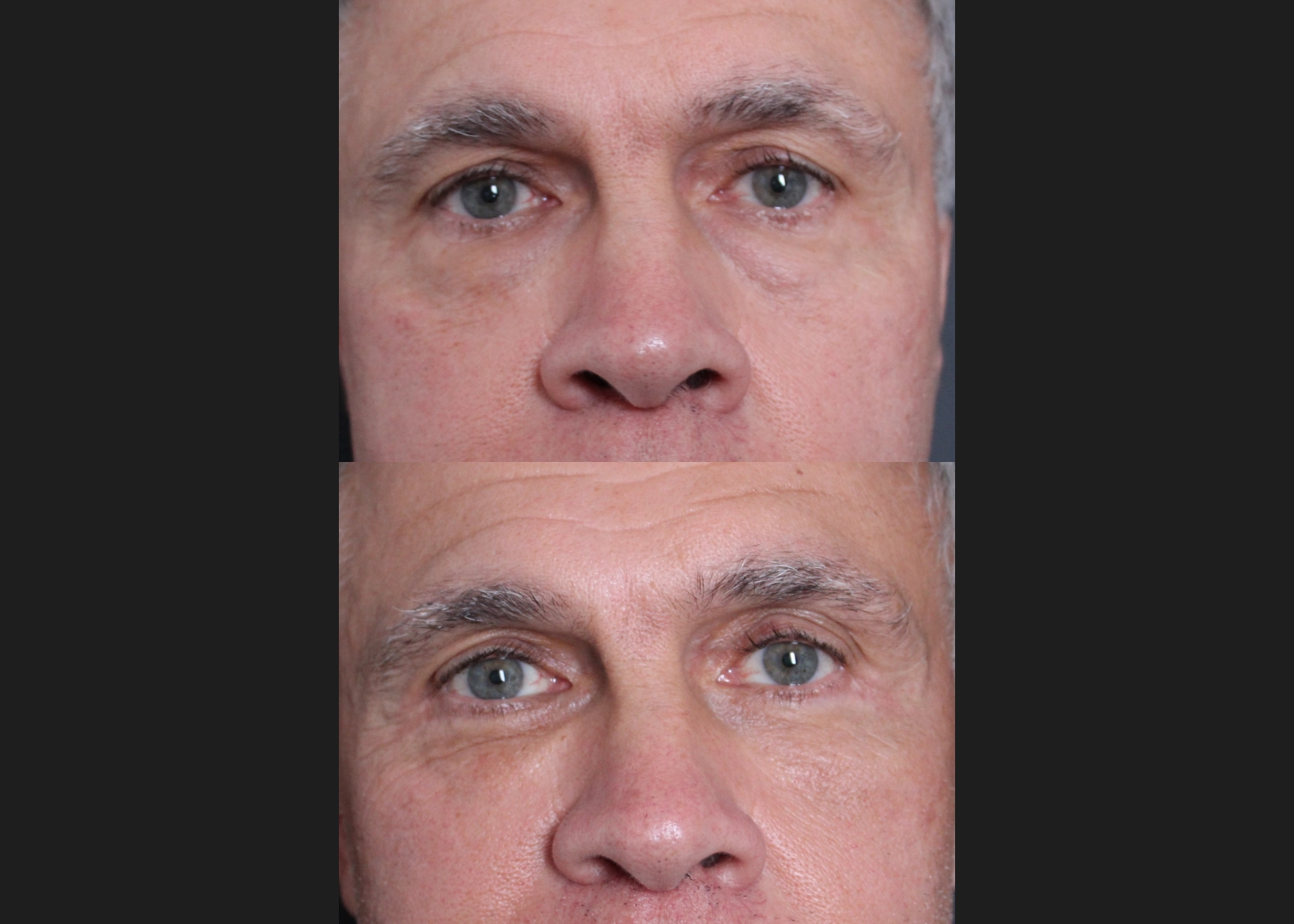 Lower Blepharoplasty with Fat Transfer, Canthopexy, Fat Transfer to Medial Cheek Male Before After 5 months – FRONT