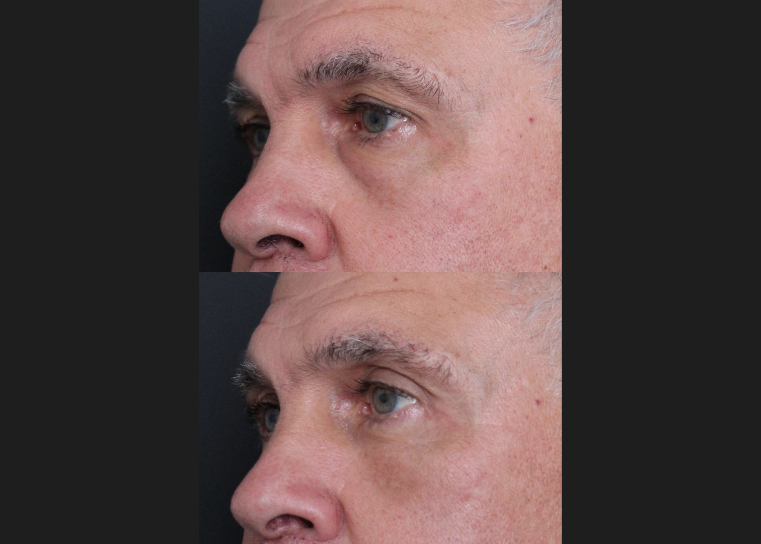 Lower Blepharoplasty with Fat Transfer, Canthopexy, Fat Transfer to Medial Cheek Male Before After 5 months – LEFT OBLIQUE