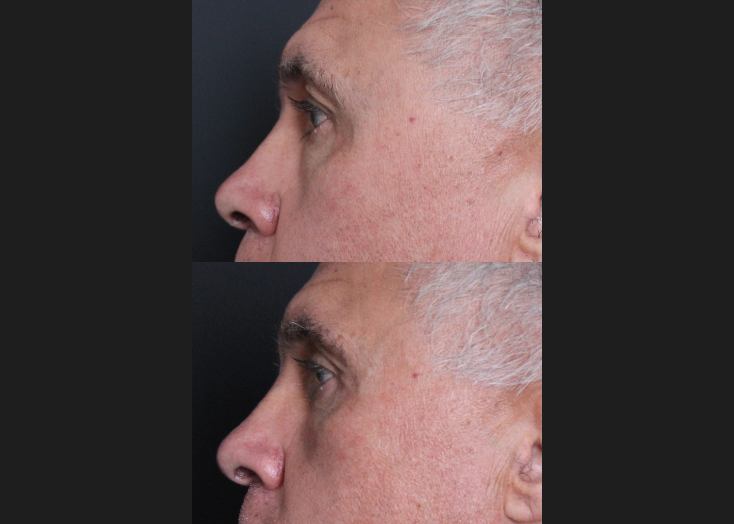 Lower Blepharoplasty with Fat Transfer, Canthopexy, Fat Transfer to Medial Cheek Male Before After 5 months – LEFT_