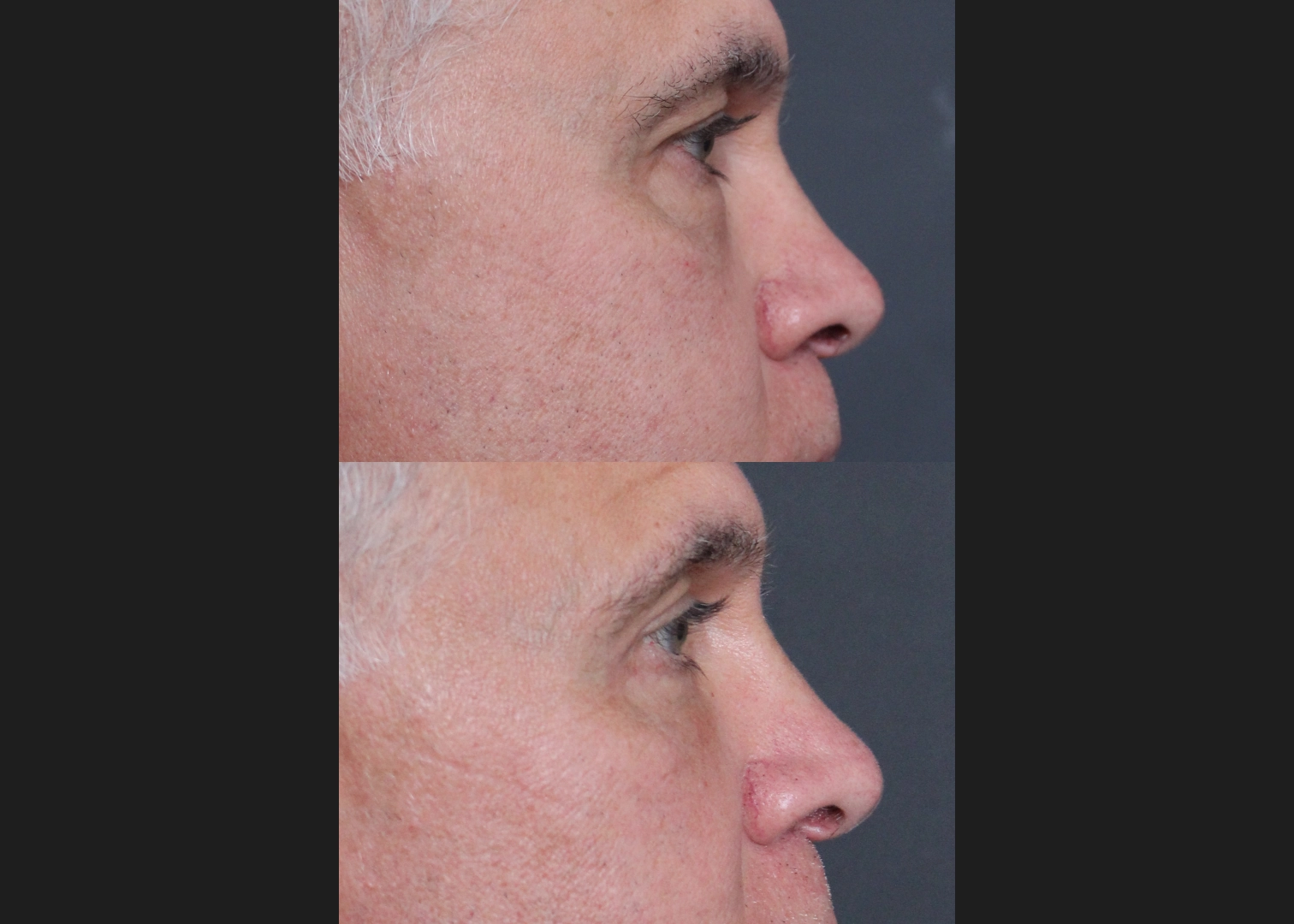Lower Blepharoplasty with Fat Transfer, Canthopexy, Fat Transfer to Medial Cheek Male Before After 5 months – RIGHT