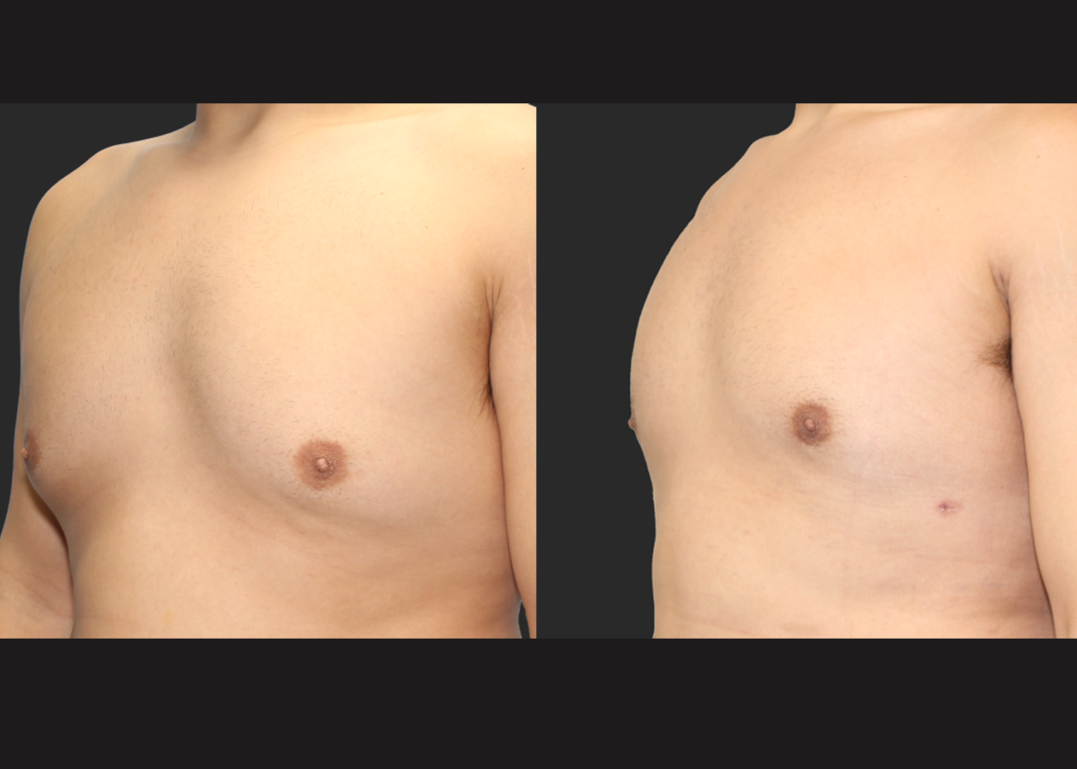 Male-Massive-Weightloss-Lipo-360-Renuvion-abdomen-back-chest-gynecomastia-before-after-left-oblique