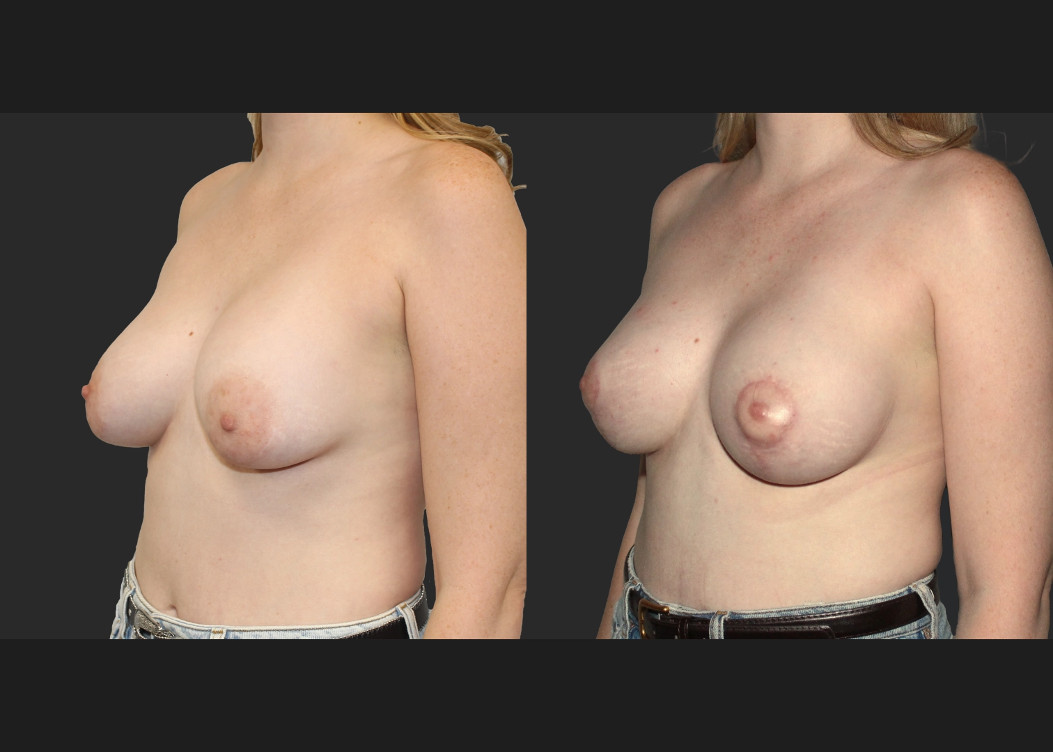 Remove Replace saline implant L capsulectomy mastopexy before after 3 months- L oblique