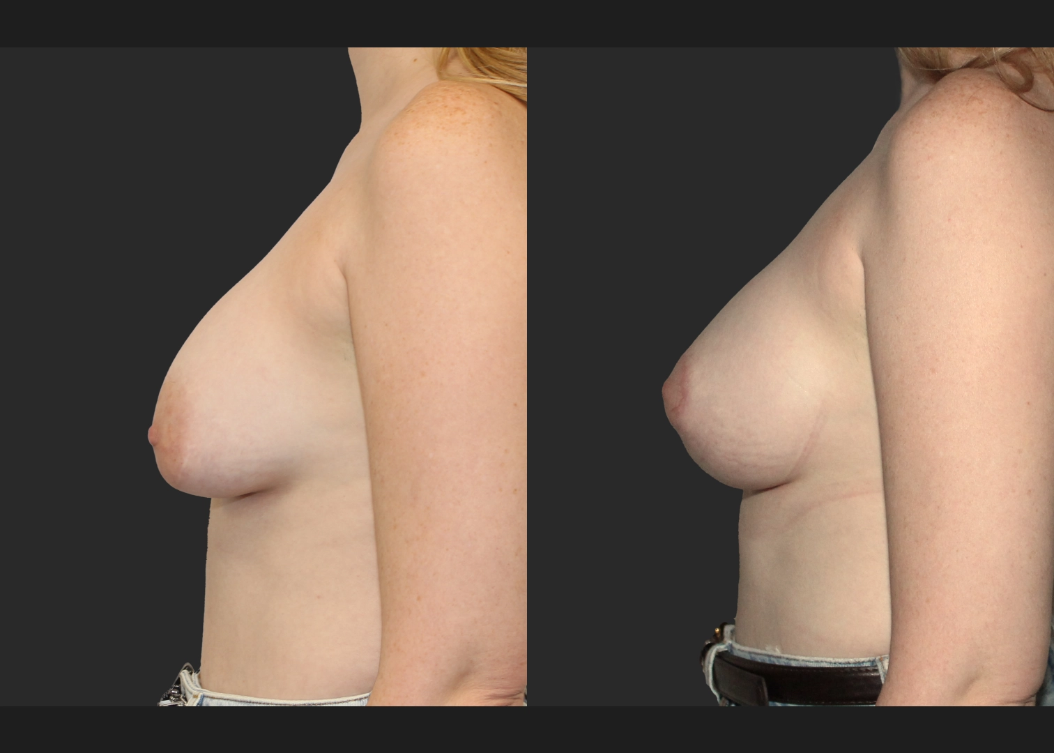 Remove Replace saline implant L capsulectomy mastopexy before after 3 months- Left