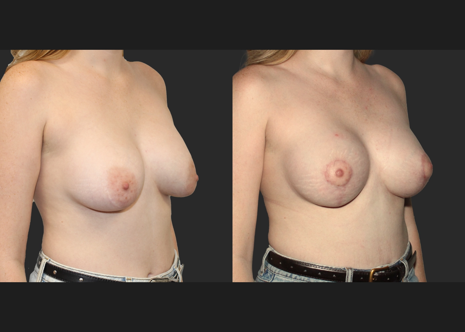 Remove Replace saline implant L capsulectomy mastopexy before after 3 months- R oblique