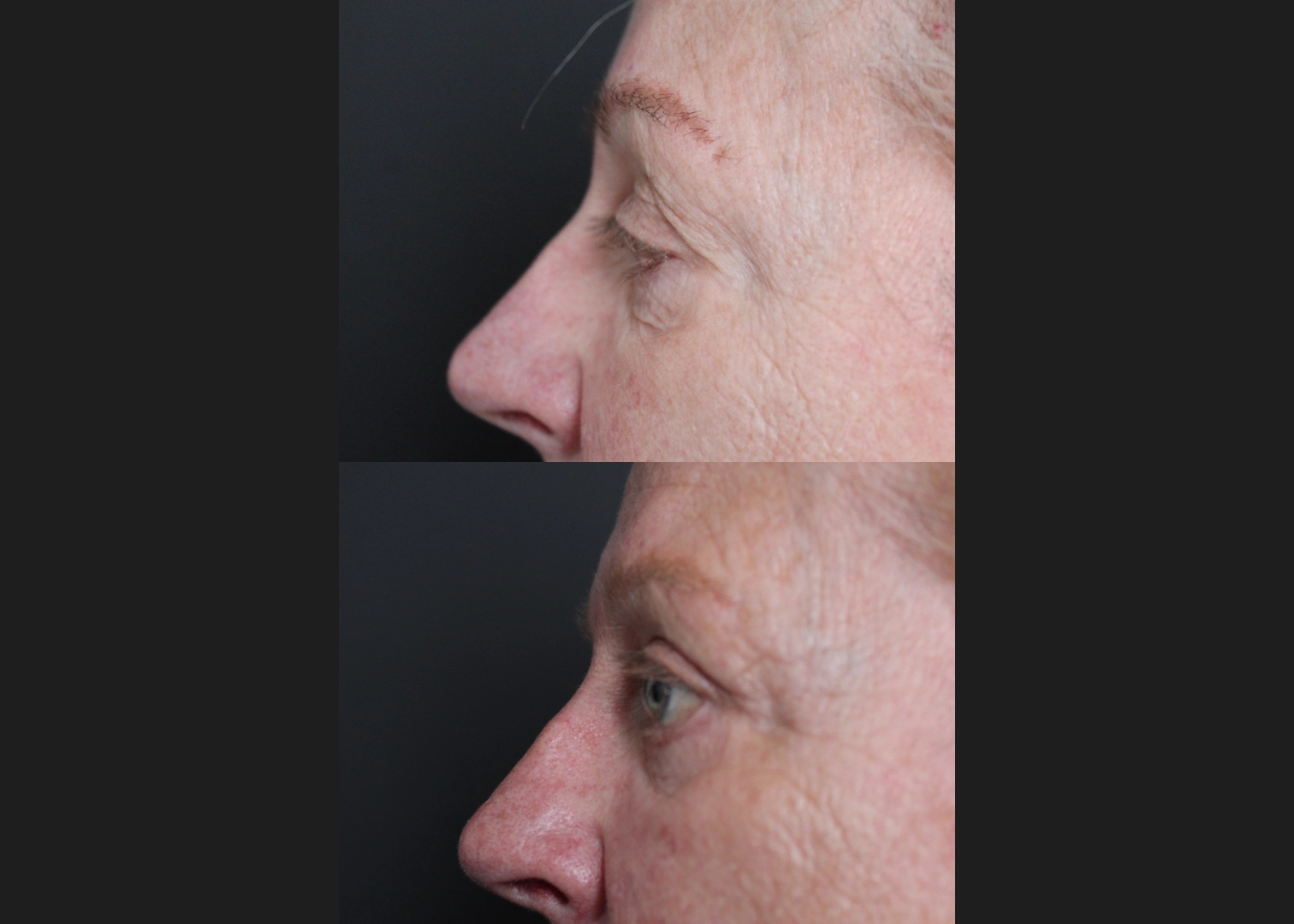Upper Blepharoplasty Before After- left