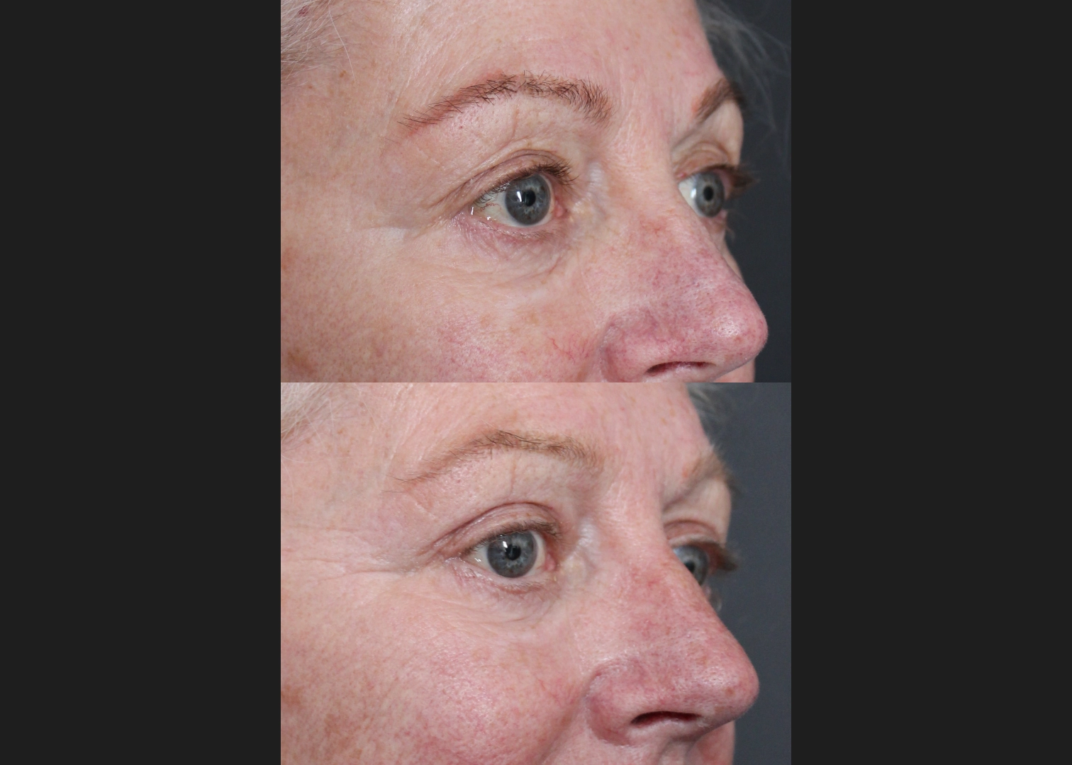 Upper Blepharoplasty Before After- right oblique