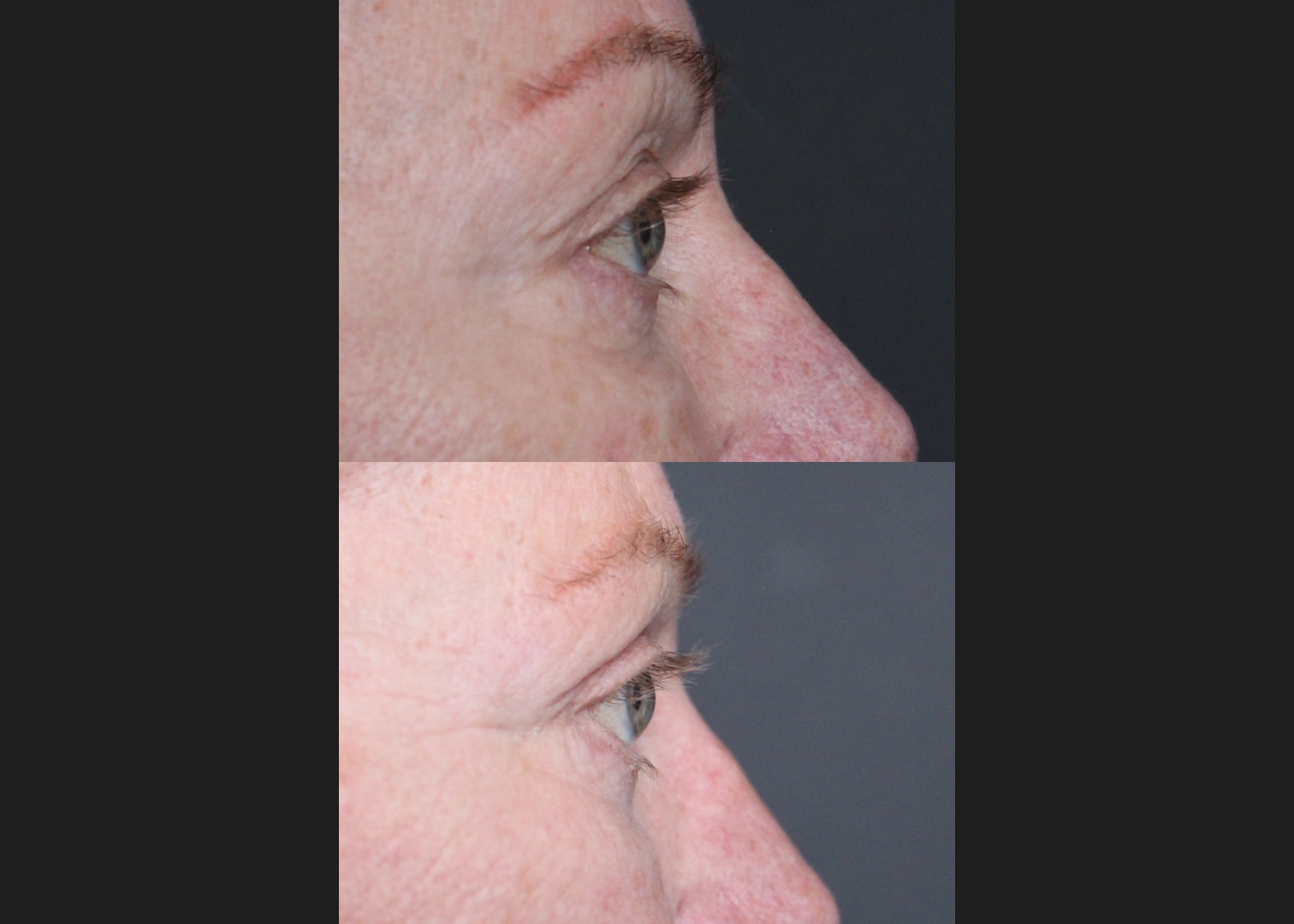 Upper Blepharoplasty Before After- right