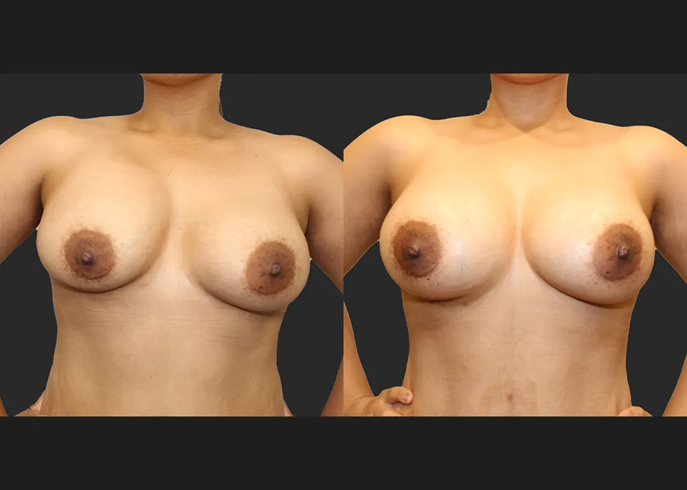 135413 Implant Exchange Natrelle SRF 560 cc Right capsulectomy galaflex lite scaffold_Before After 6 wks_Front Flexed