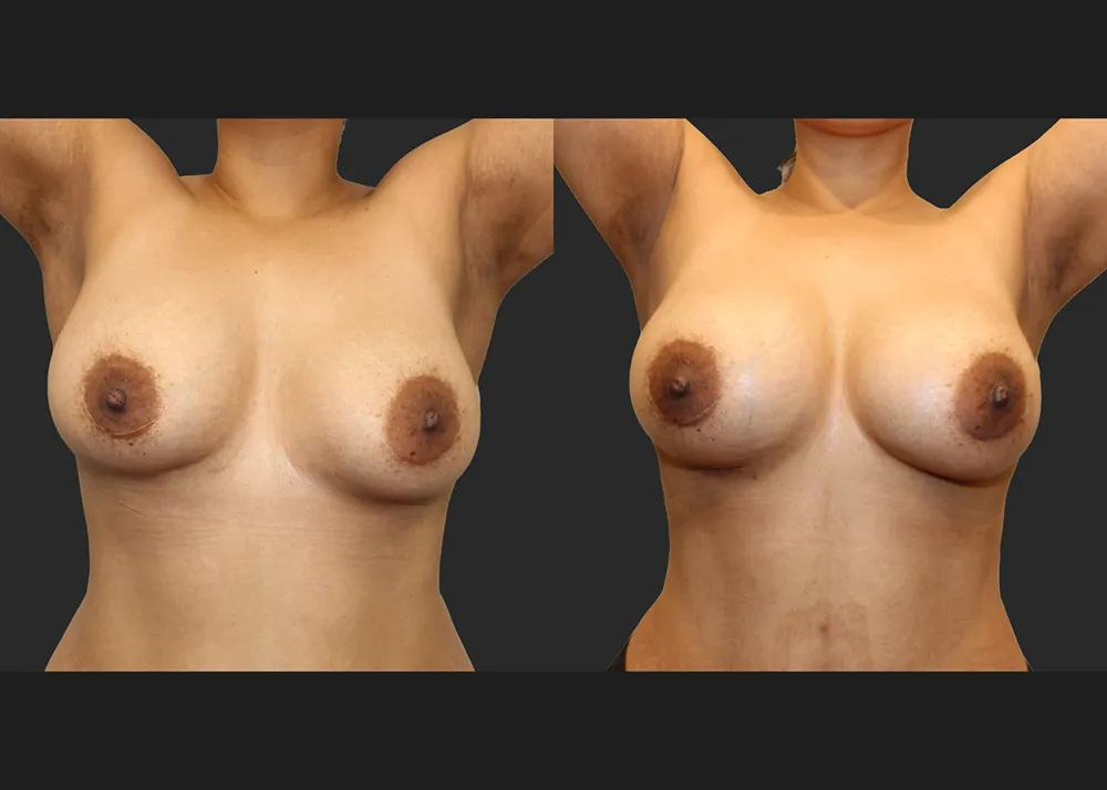 135413 Implant Exchange Natrelle SRF 560 cc Right capsulectomy galaflex lite scaffold_Before After 6 wks_Front up