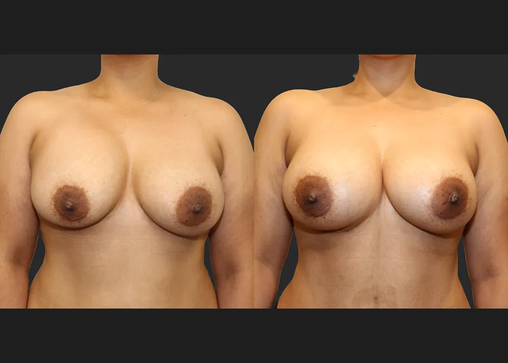 135413 Implant Exchange Natrelle SRF 560 cc Right capsulectomy galaflex lite scaffold_Before After 6 wks_Front