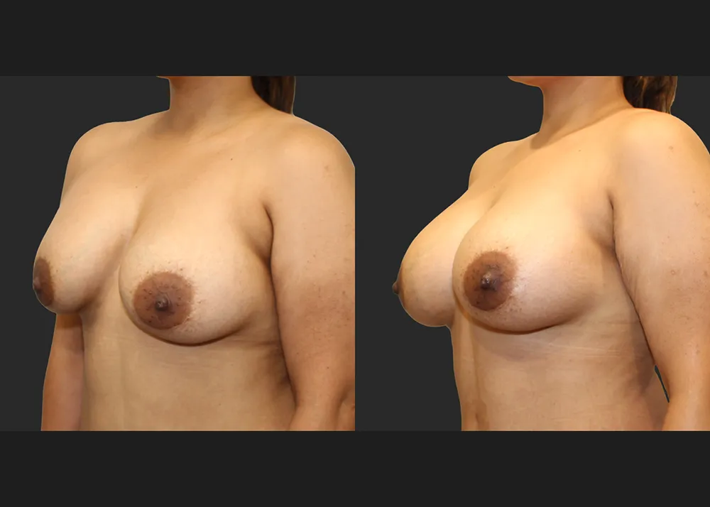 135413 Implant Exchange Natrelle SRF 560 cc Right capsulectomy galaflex lite scaffold_Before After 6 wks_Front_L oblique