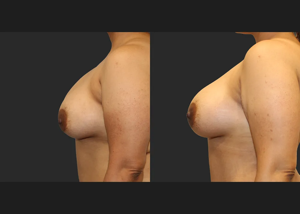 135413 Implant Exchange Natrelle SRF 560 cc Right capsulectomy galaflex lite scaffold_Before After 6 wks_Front_Left