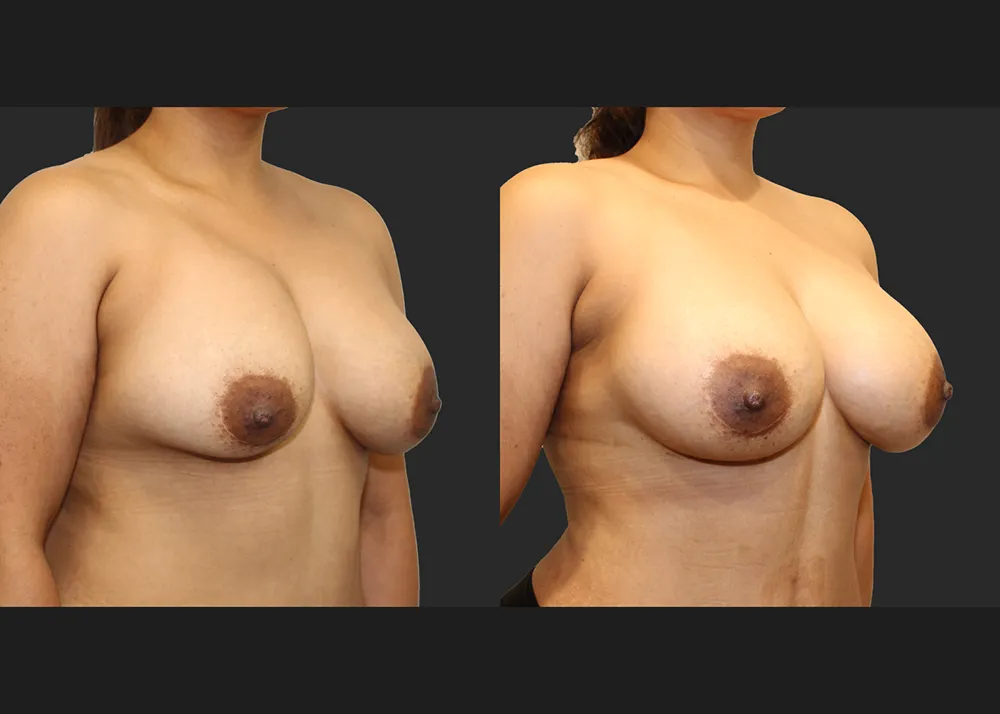 135413 Implant Exchange Natrelle SRF 560 cc Right capsulectomy galaflex lite scaffold_Before After 6 wks_Front_R oblique