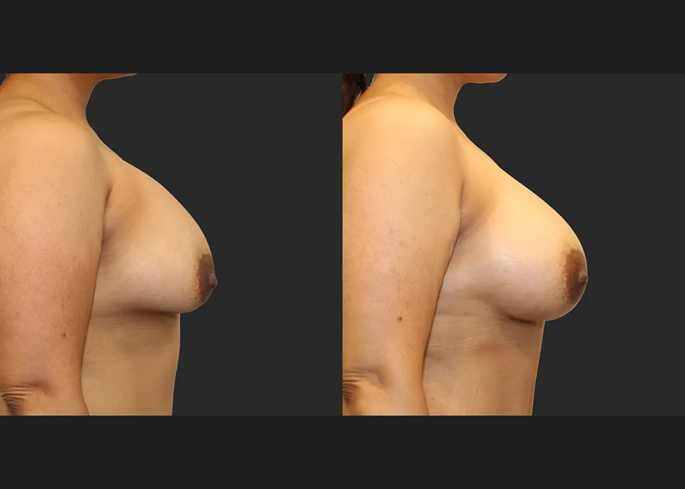 135413 Implant Exchange Natrelle SRF 560 cc Right capsulectomy galaflex lite scaffold_Before After 6 wks_Front_Right