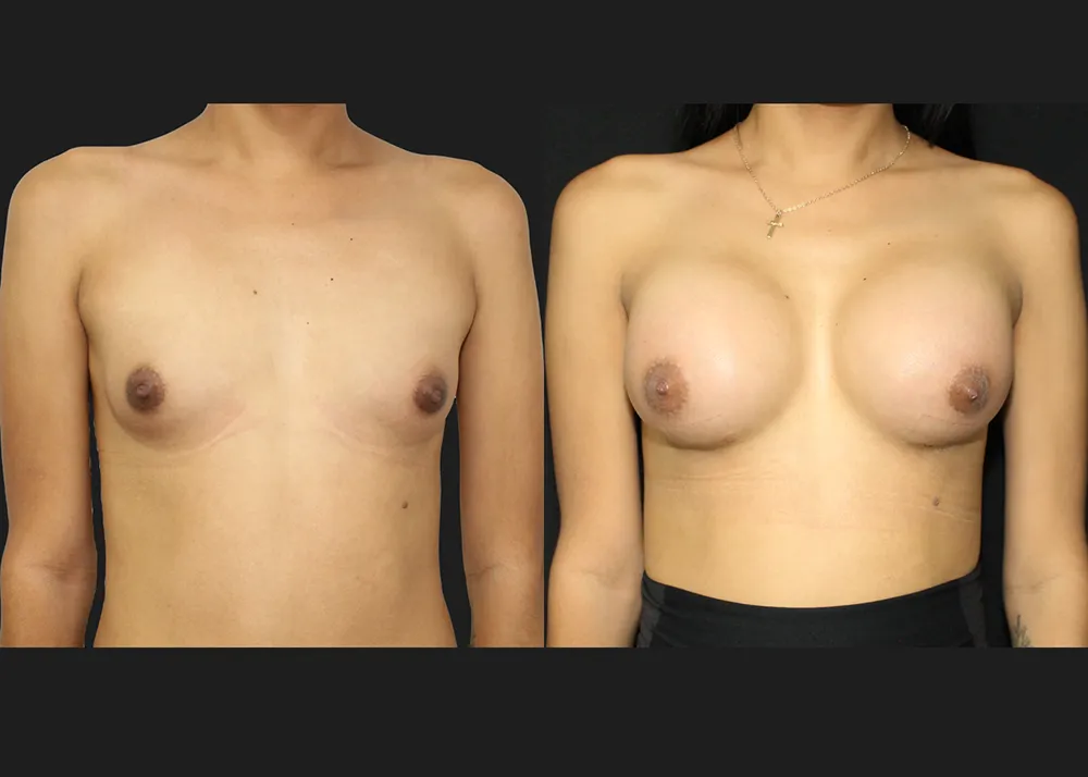 20250910-1 Breast Augmentation MTF Top Surgery Allergan Saline Implants High Profile 400 cc submuscular dual plane Before After 6 weeks Front