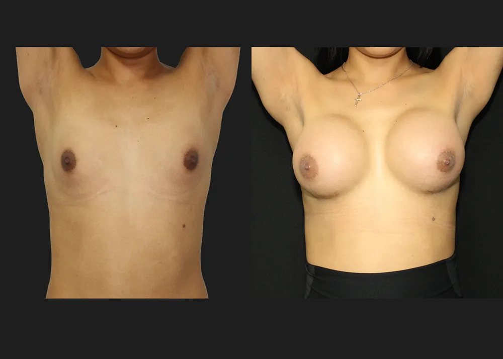 20250910-1 Breast Augmentation MTF Top Surgery Allergan Saline Implants High Profile 400 cc submuscular dual plane Before After 6 weeks front up